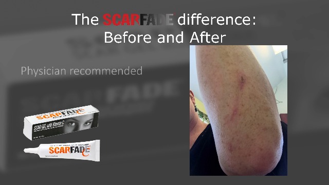 Amazon.com: Scarfade Silicone Gel for Scar Repair - 15g : Health